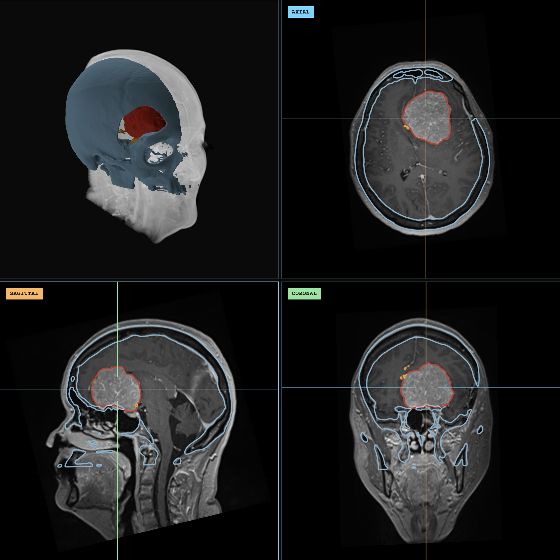 A 3D anatomical model alongside axial, sagittal, and coronal MRI views
