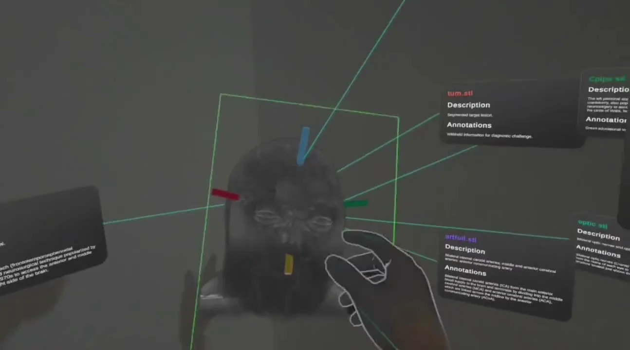 Patient-specific 3D head model with surgical corridors and labelled anatomy cards, explored by hand in the Argus VR headset view